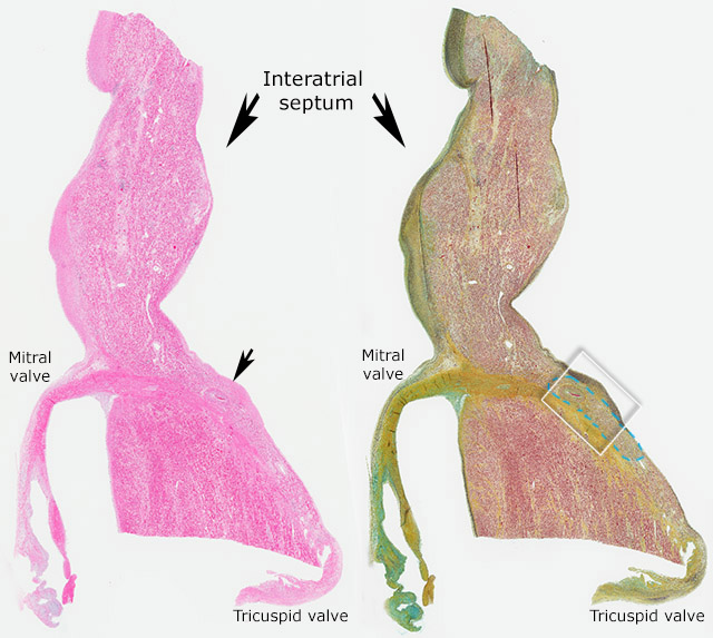 AV Node artery with allograft vasculopathy H&E & Movat